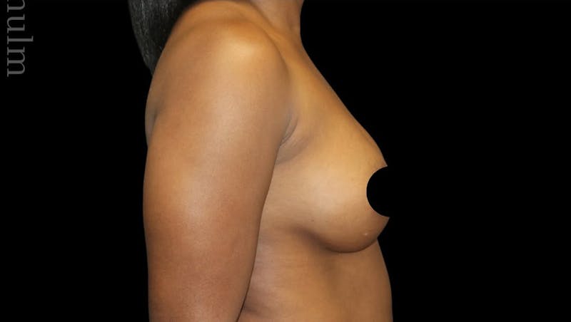 Breast Augmentation Before & After Gallery - Patient 139047 - Image 4