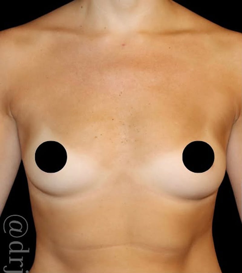 Breast Augmentation Before & After Gallery - Patient 300608 - Image 1
