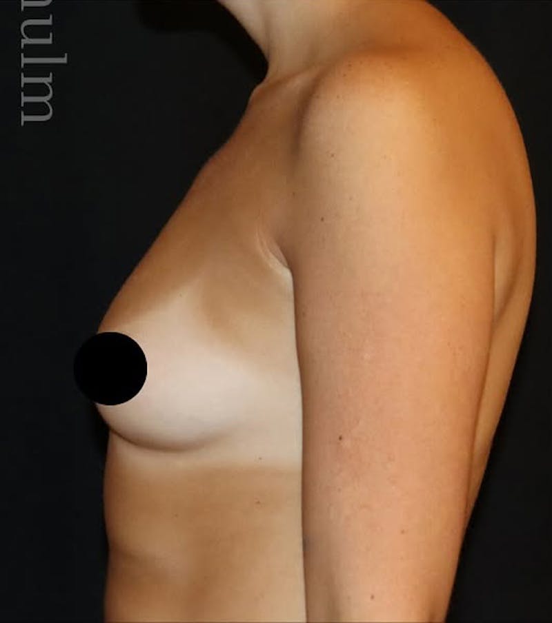 Breast Augmentation Before & After Gallery - Patient 300608 - Image 3