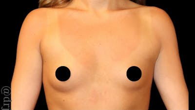 Breast Augmentation Before & After Gallery - Patient 170239 - Image 1