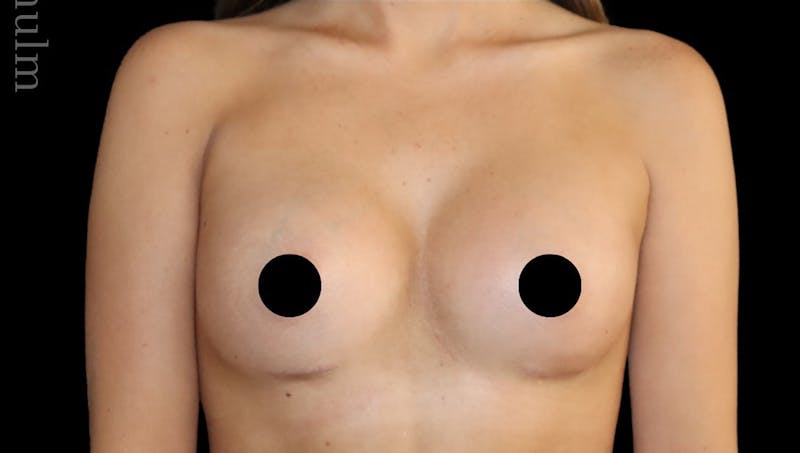 Breast Augmentation Before & After Gallery - Patient 170239 - Image 2