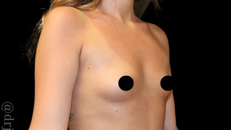 Breast Augmentation Before & After Gallery - Patient 170239 - Image 3
