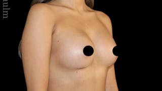 Breast Augmentation Before & After Gallery - Patient 170239 - Image 4