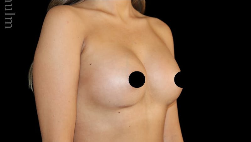 Breast Augmentation Before & After Gallery - Patient 170239 - Image 4