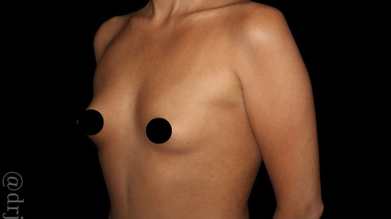 Breast Augmentation Before & After Gallery - Patient 170239 - Image 5