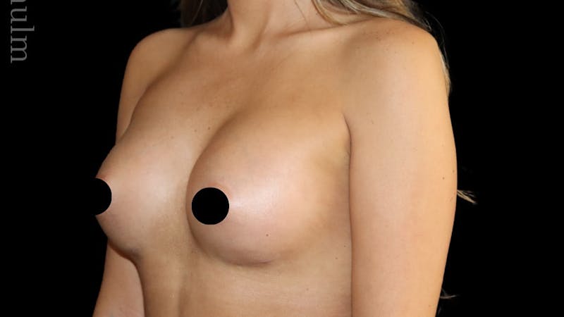 Breast Augmentation Before & After Gallery - Patient 170239 - Image 6