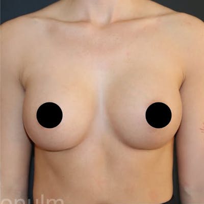 Breast Augmentation Before & After Gallery - Patient 198378 - Image 2