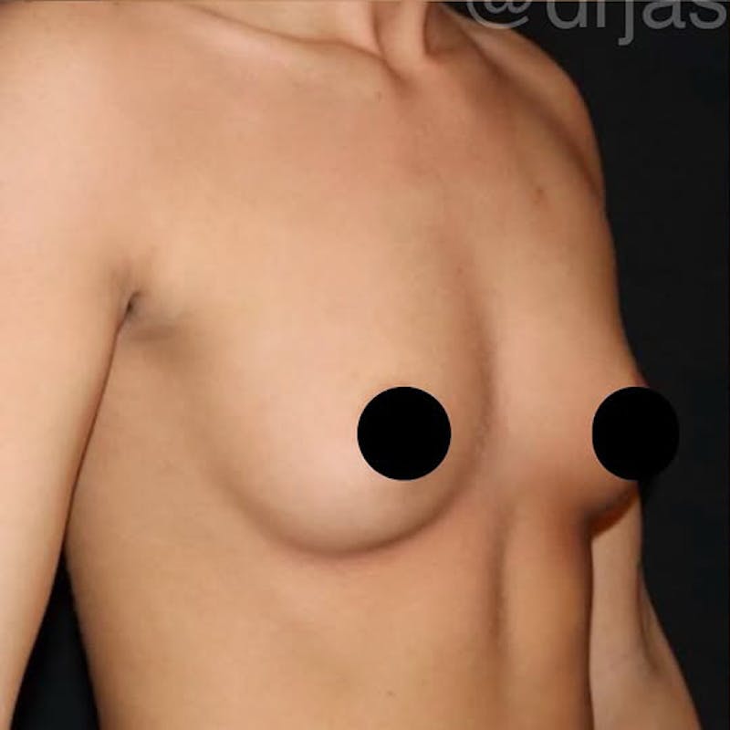 Breast Augmentation Before & After Gallery - Patient 198378 - Image 3