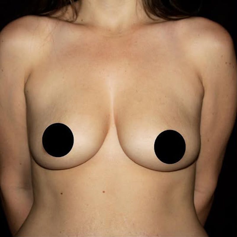 Breast Augmentation Before & After Gallery - Patient 425749 - Image 1