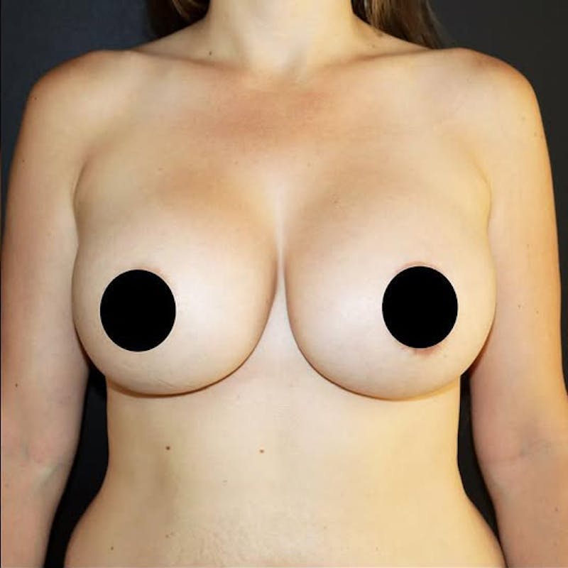 Breast Augmentation Before & After Gallery - Patient 425749 - Image 2