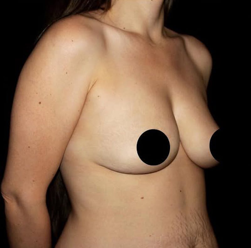 Breast Augmentation Before & After Gallery - Patient 425749 - Image 3