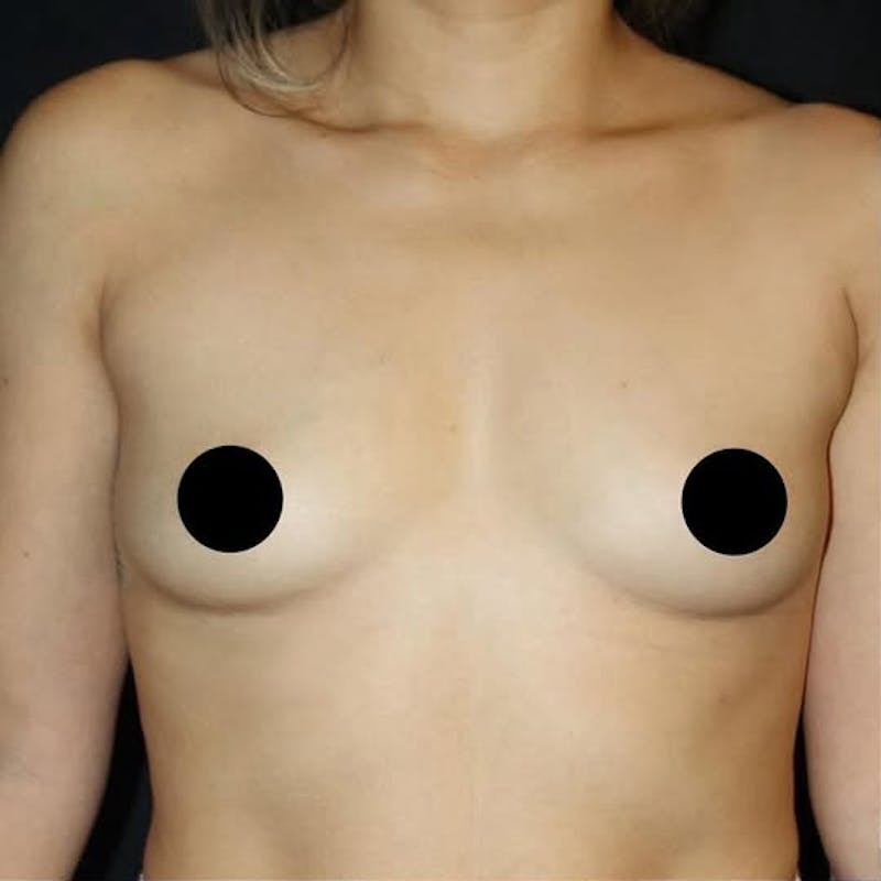 Breast Augmentation Before & After Gallery - Patient 229679 - Image 1