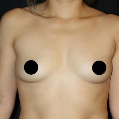 Breast Augmentation Before & After Gallery - Patient 229679 - Image 1