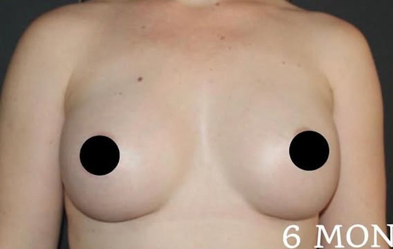 Breast Augmentation Before & After Gallery - Patient 377493 - Image 2