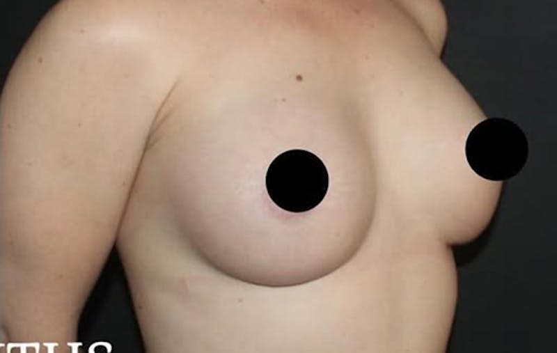 Breast Augmentation Before & After Gallery - Patient 377493 - Image 6
