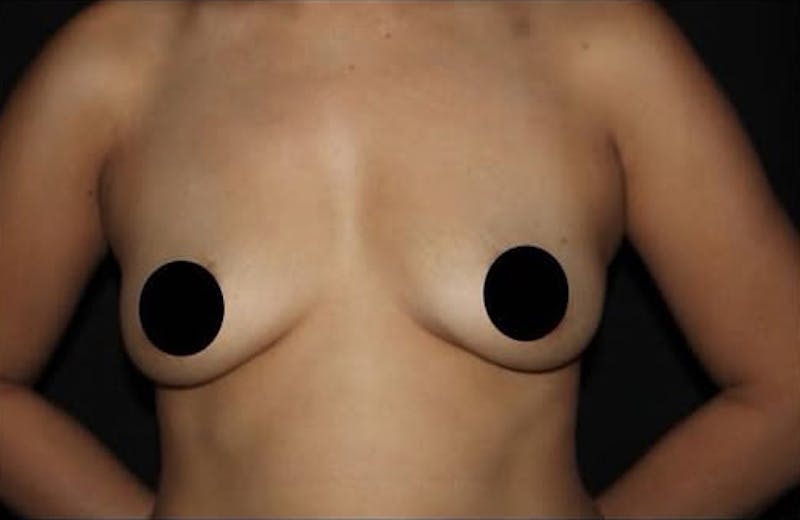 Breast Augmentation Before & After Gallery - Patient 995138 - Image 1