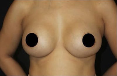 Breast Augmentation Before & After Gallery - Patient 995138 - Image 2