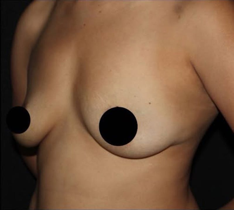 Breast Augmentation Before & After Gallery - Patient 995138 - Image 5