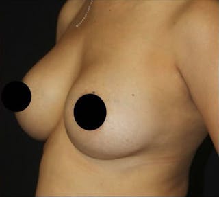 Breast Augmentation Before & After Gallery - Patient 995138 - Image 6