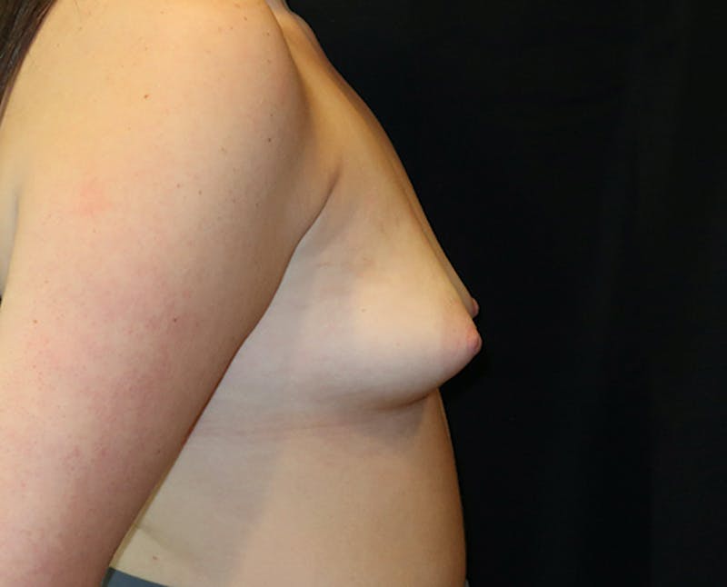 Breast Augmentation Before & After Gallery - Patient 334755 - Image 5
