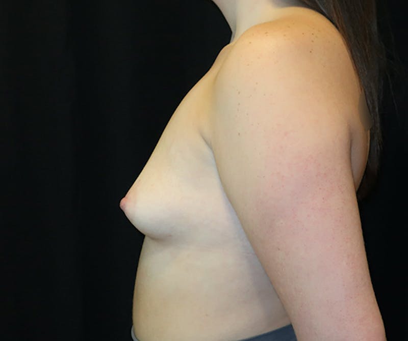 Breast Augmentation Before & After Gallery - Patient 334755 - Image 9