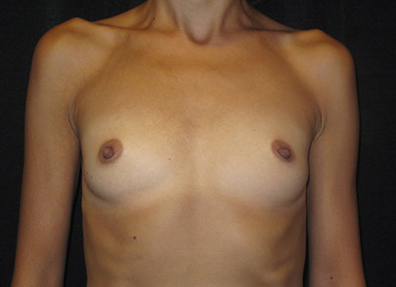 Breast Augmentation Before & After Gallery - Patient 321965 - Image 1