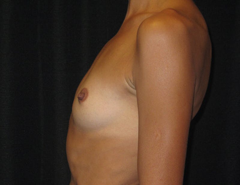 Breast Augmentation Before & After Gallery - Patient 321965 - Image 9