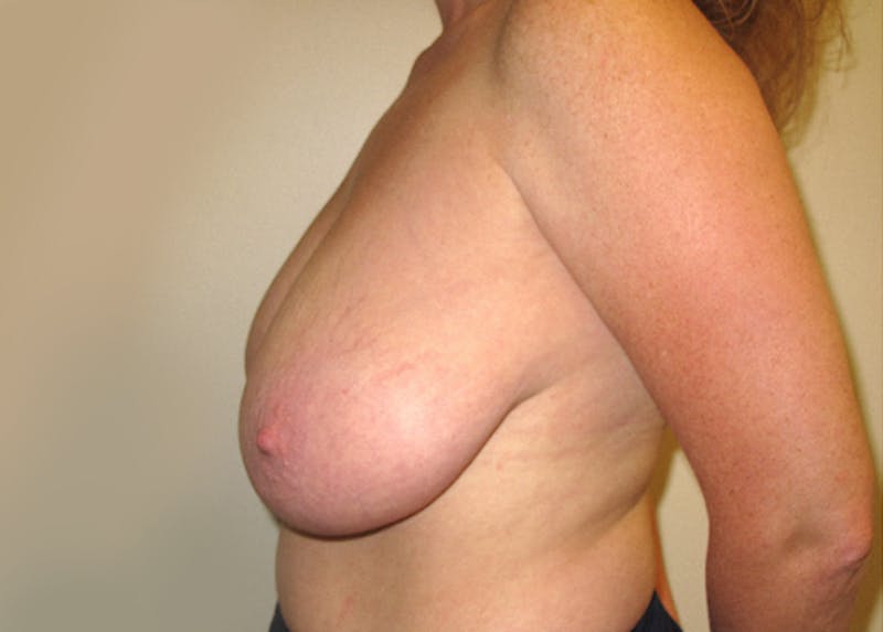 Breast Reduction Before & After Gallery - Patient 122653 - Image 5