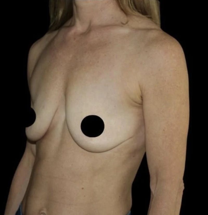 Breast Lift Before & After Gallery - Patient 222780 - Image 1