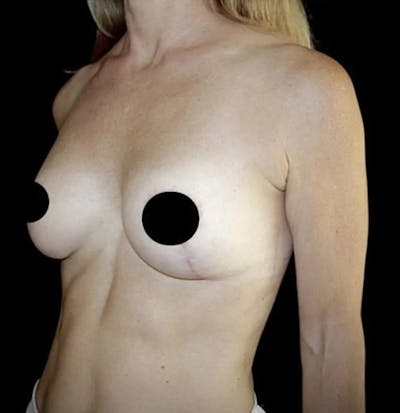 Breast Lift Before & After Gallery - Patient 222780 - Image 2