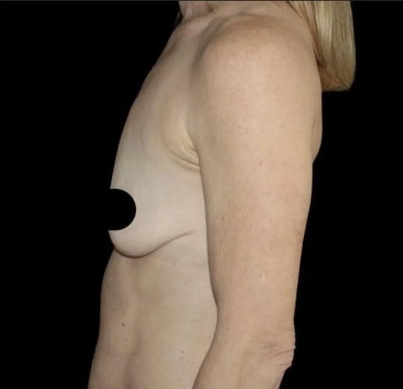 Breast Lift Before & After Gallery - Patient 222780 - Image 3
