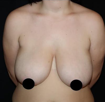 Breast Lift Before & After Gallery - Patient 264338 - Image 1