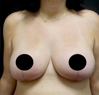 Breast Lift Before & After Gallery - Patient 264338 - Image 2