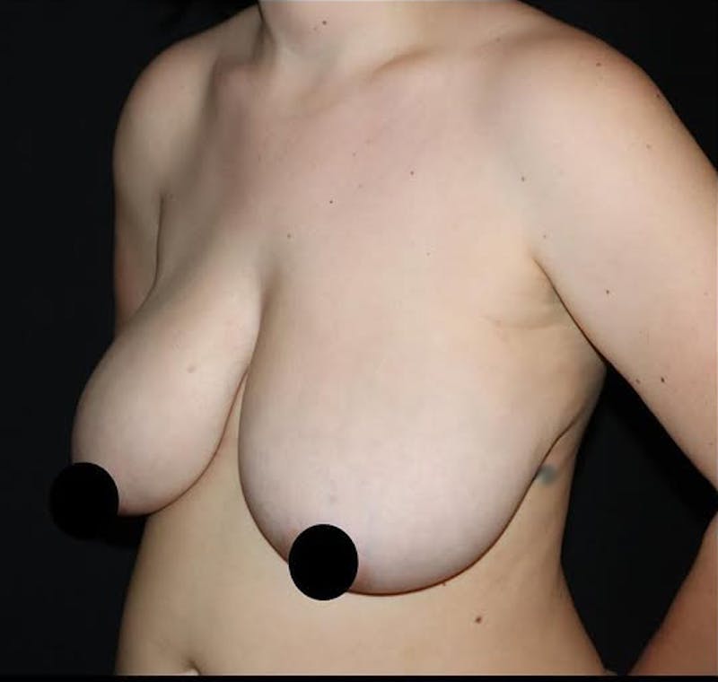 Breast Lift Before & After Gallery - Patient 264338 - Image 3