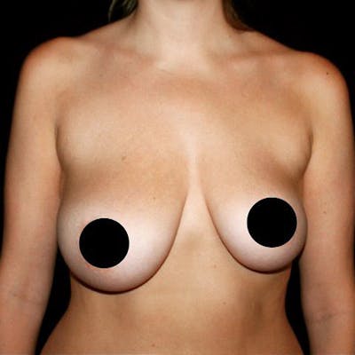 Breast Lift Before & After Gallery - Patient 208459 - Image 1