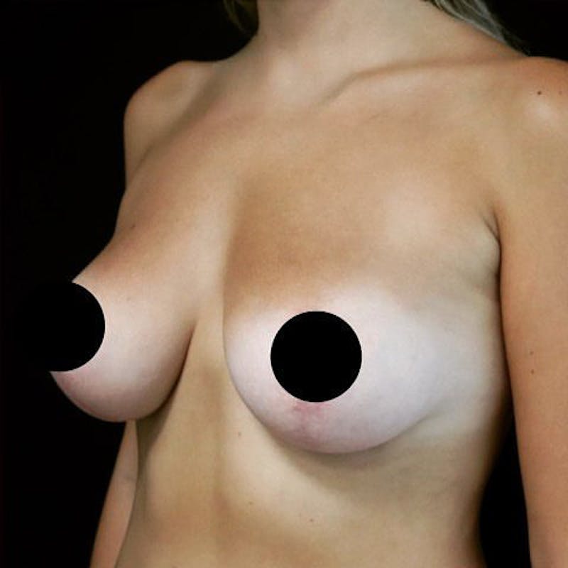 Breast Fat Transfer Before & After Gallery - Patient 301583 - Image 4