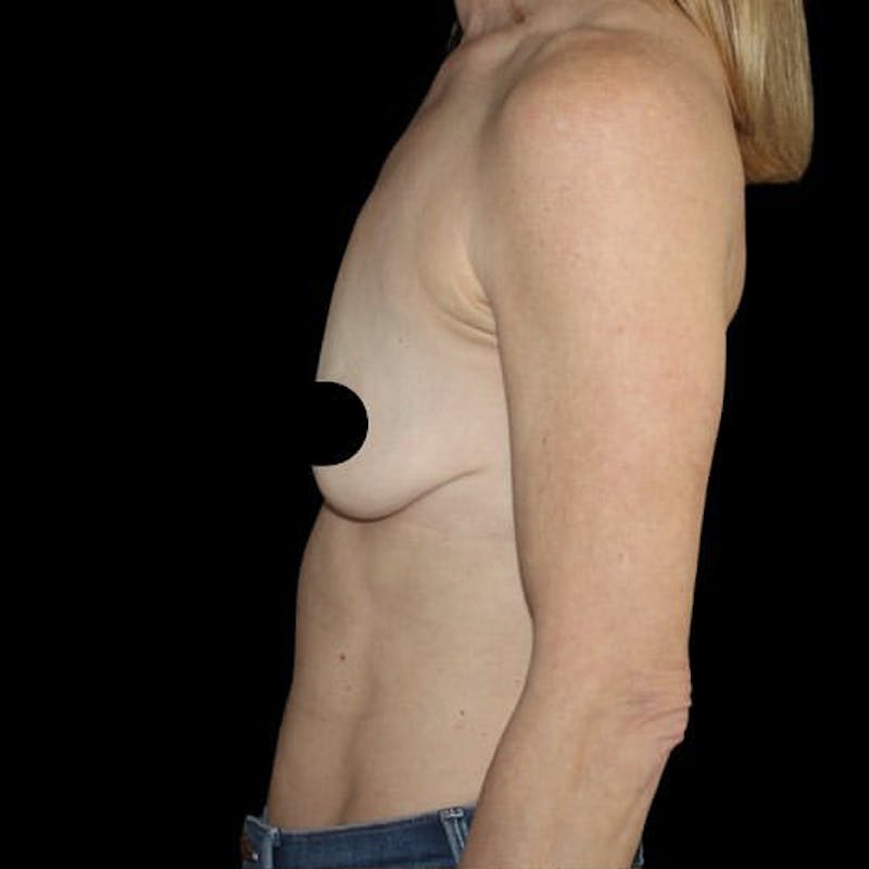 Breast Lift Before & After Gallery - Patient 267264 - Image 3