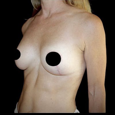 Breast Lift Before & After Gallery - Patient 267264 - Image 2