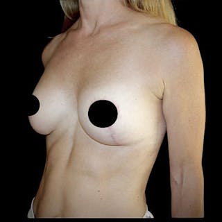 Breast Lift Before & After Gallery - Patient 267264 - Image 2