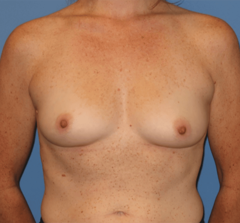 Breast Reconstruction Before & After Gallery - Patient 210040 - Image 1