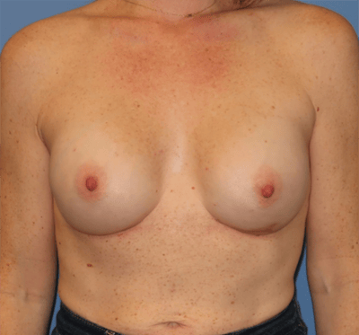 Breast Reconstruction Before & After Gallery - Patient 210040 - Image 2