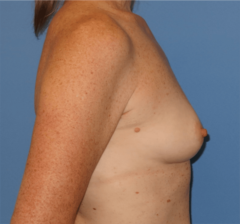 Breast Reconstruction Before & After Gallery - Patient 210040 - Image 5