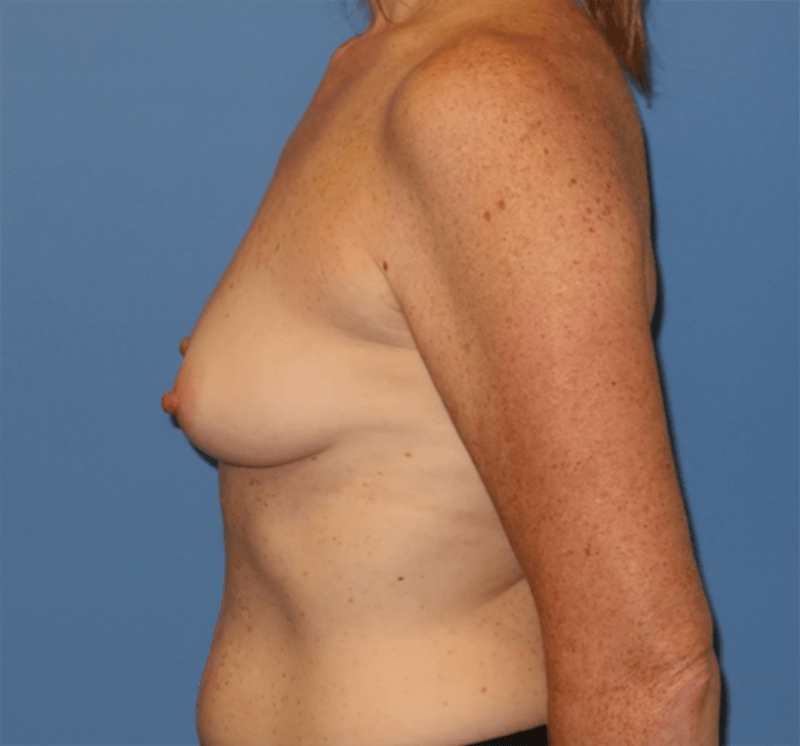 Breast Reconstruction Before & After Gallery - Patient 210040 - Image 9