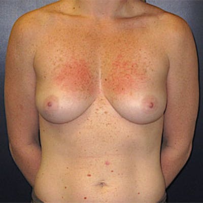 Breast Reconstruction Before & After Gallery - Patient 198533 - Image 1