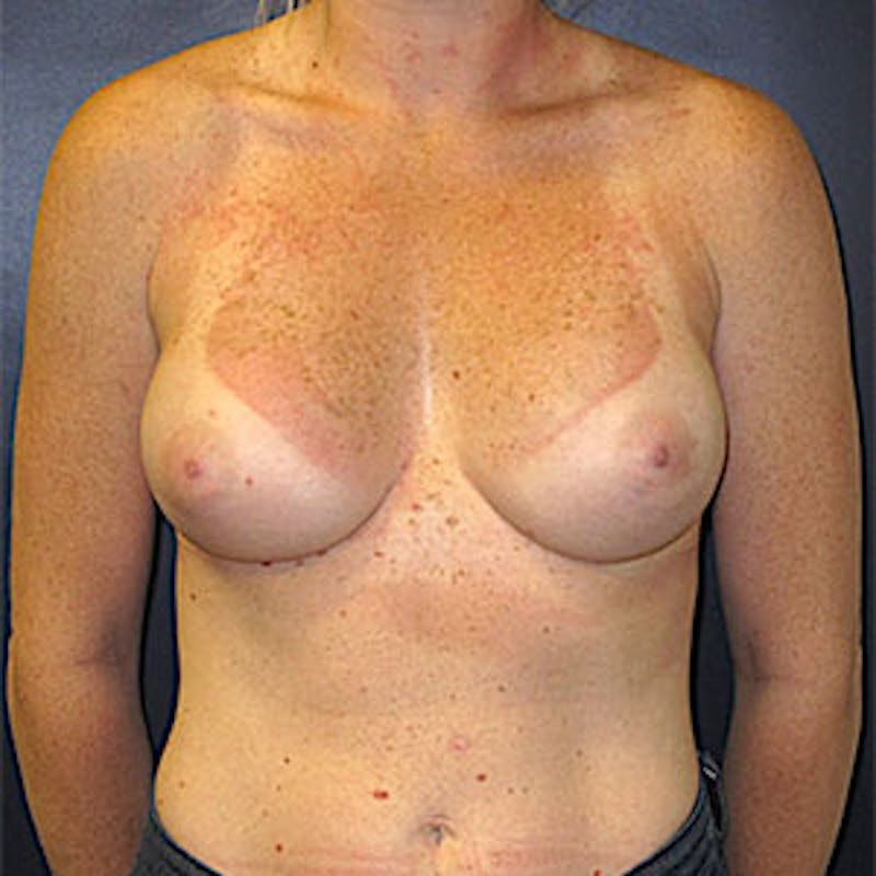Breast Reconstruction Before & After Gallery - Patient 198533 - Image 2