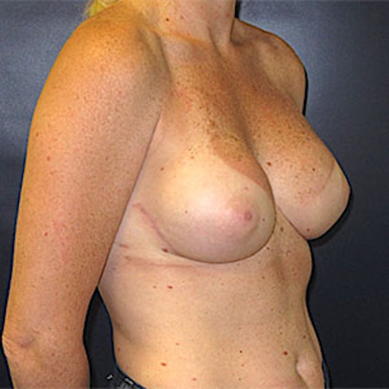 Breast Reconstruction Before & After Gallery - Patient 198533 - Image 4