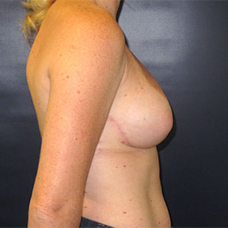 Breast Reconstruction Before & After Gallery - Patient 198533 - Image 6