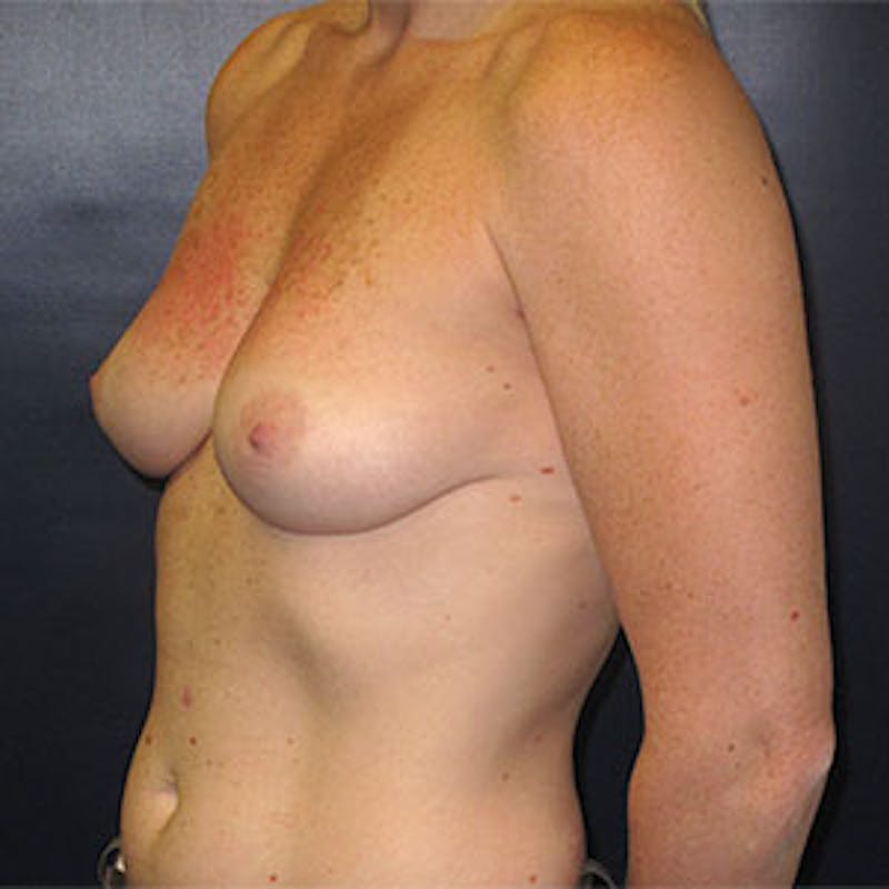 Breast Reconstruction Before & After Gallery - Patient 198533 - Image 7