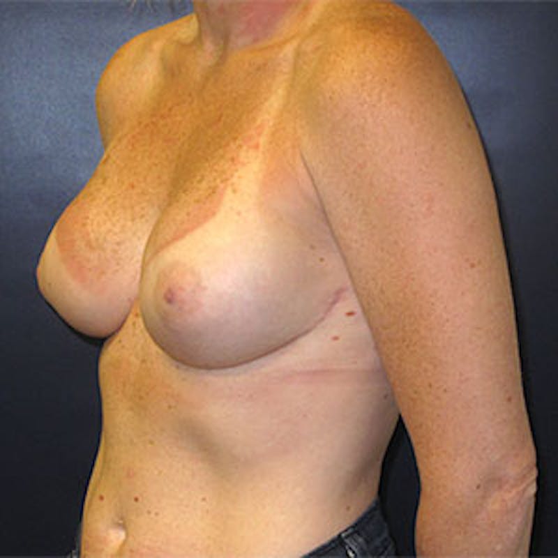 Breast Reconstruction Before & After Gallery - Patient 198533 - Image 8