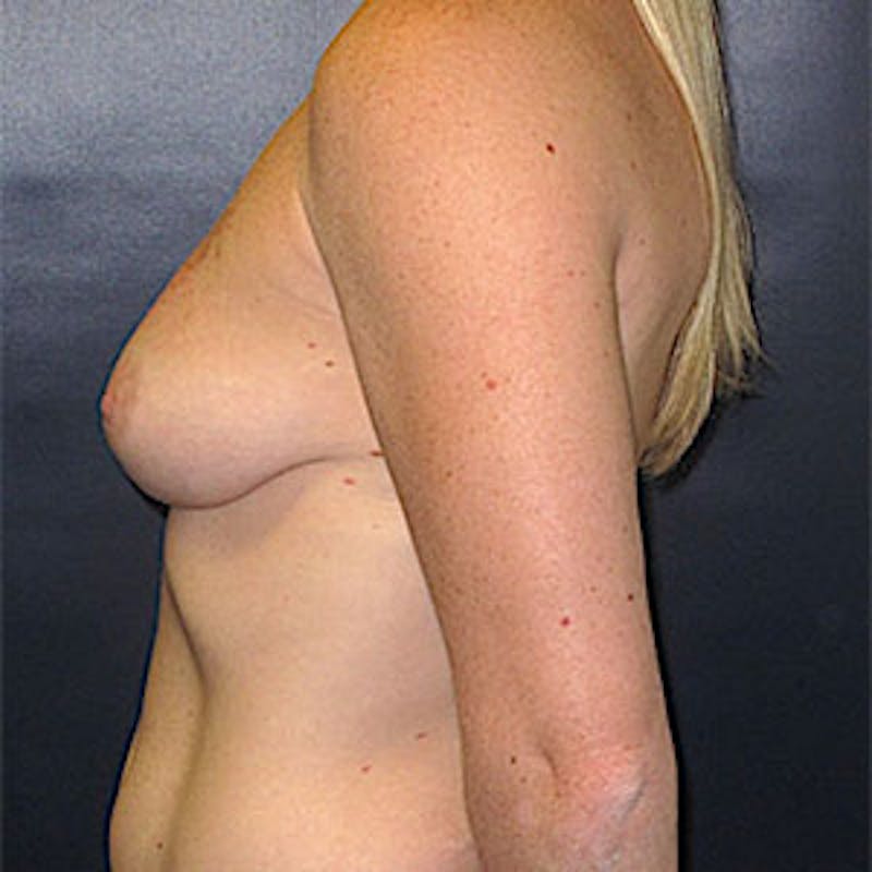 Breast Reconstruction Before & After Gallery - Patient 198533 - Image 9